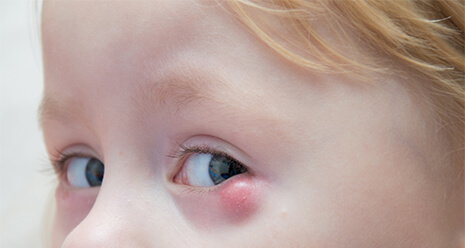 Chalazion - ThéaPharma - Know The Signs And Symptoms - Eye Care